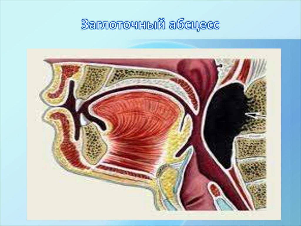 Заглоточный абсцесс