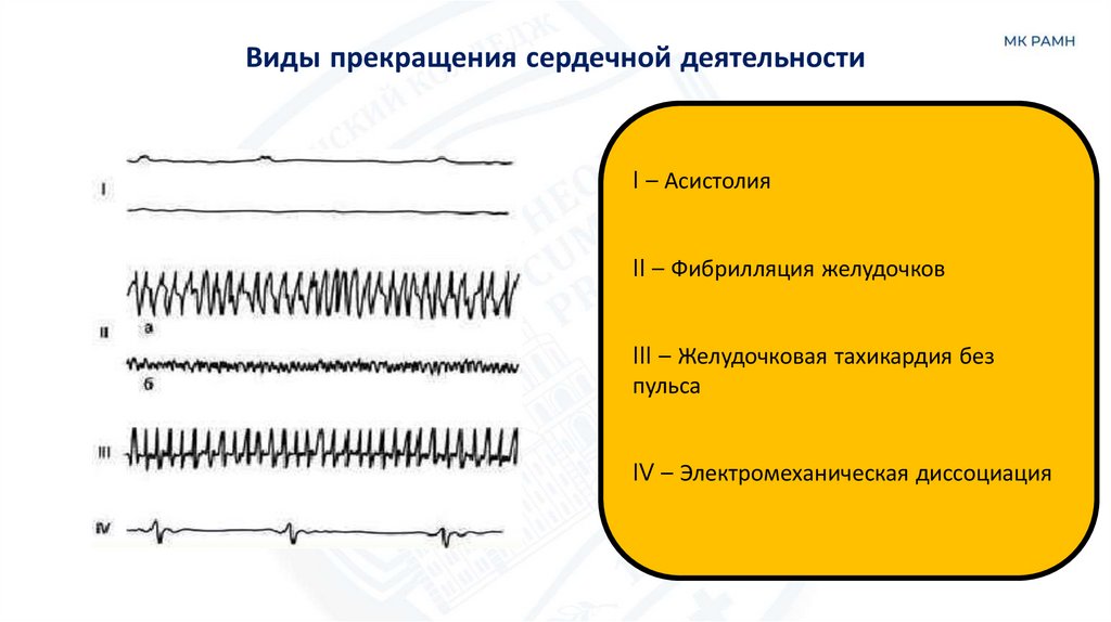 Виды прекращения сердечной деятельности