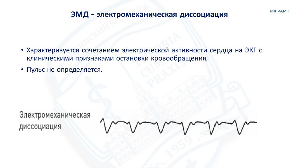 ЭМД - электромеханическая диссоциация
