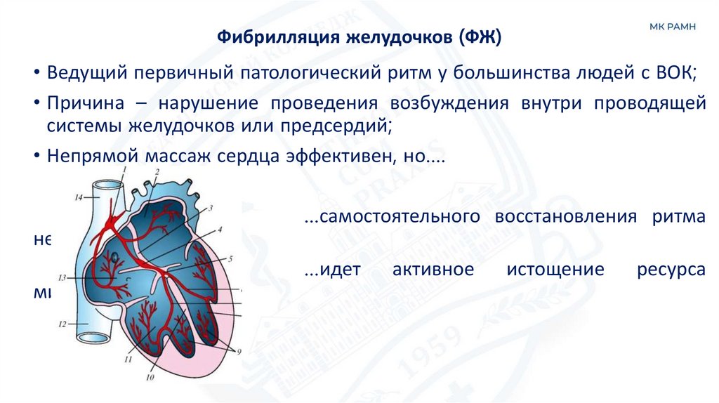 Фибрилляция желудочков (ФЖ)