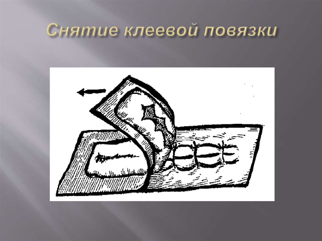 Снятие клеевой повязки