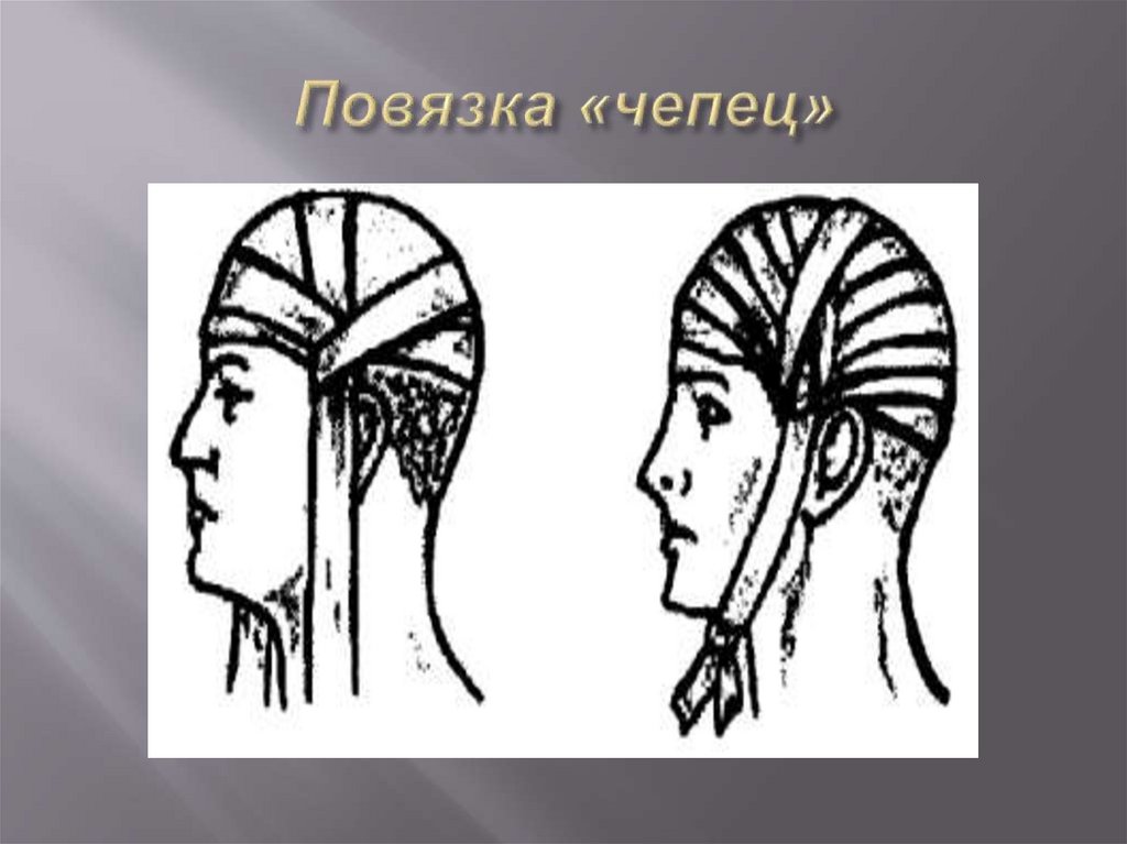 Повязка «чепец»