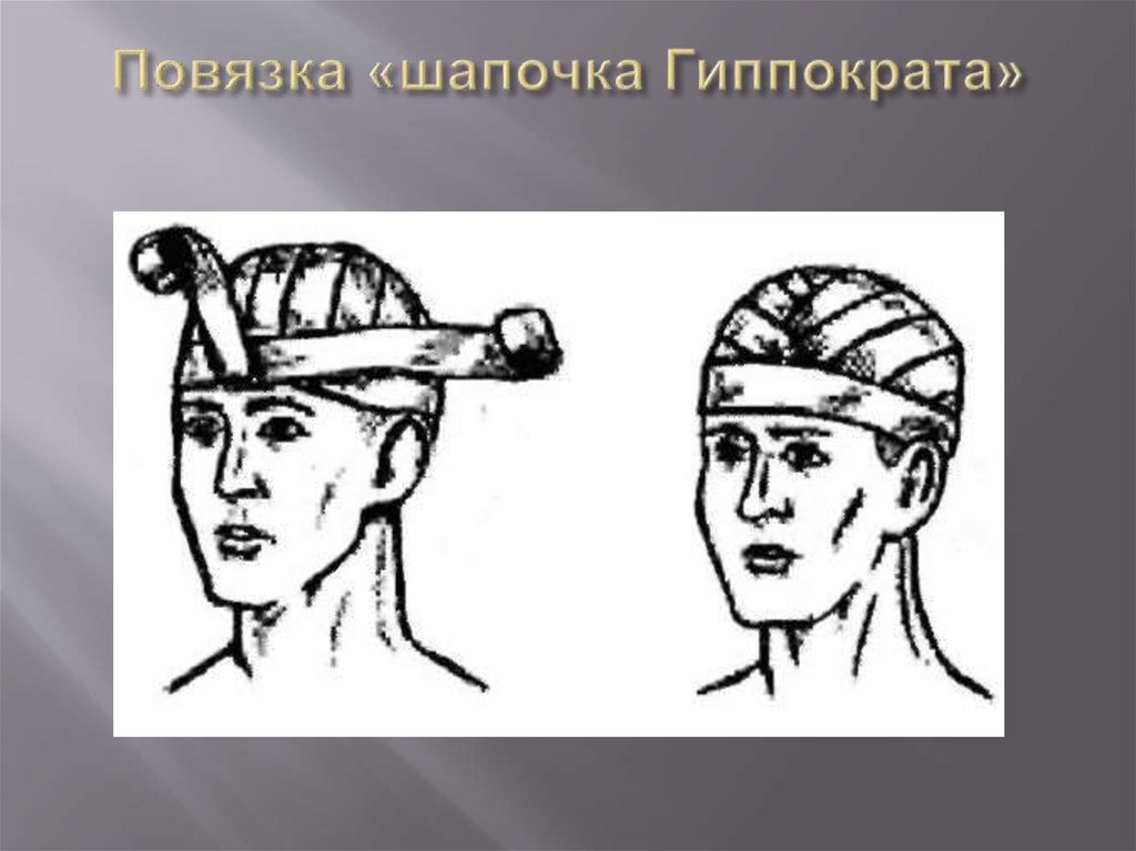Повязка «шапочка Гиппократа»