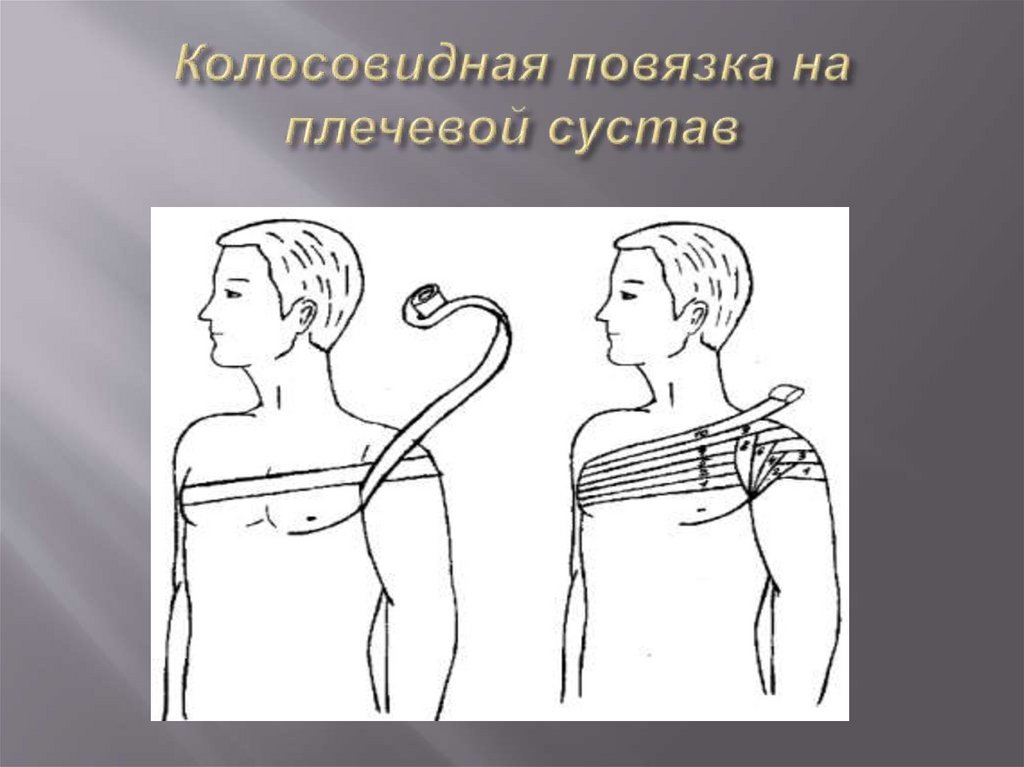 Колосовидная повязка на плечевой сустав
