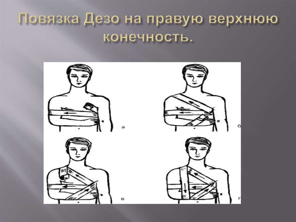 Повязка Дезо на правую верхнюю конечность.