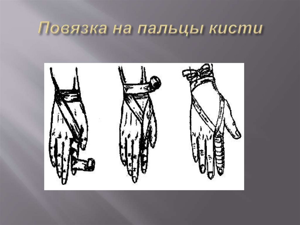 Повязка на пальцы кисти