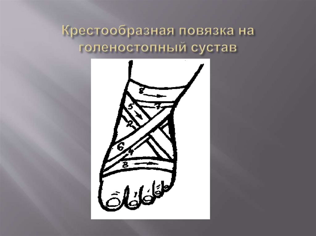 Крестообразная повязка на голеностопный сустав
