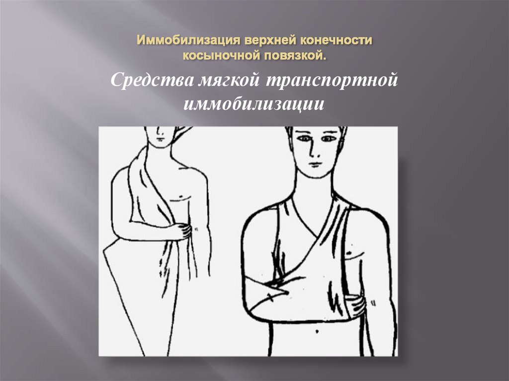 Иммобилизация верхней конечности косыночной повязкой.