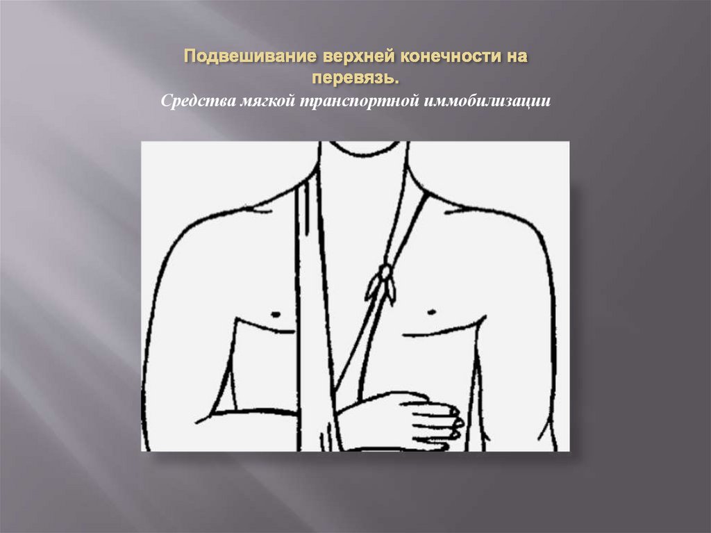 Подвешивание верхней конечности на перевязь.