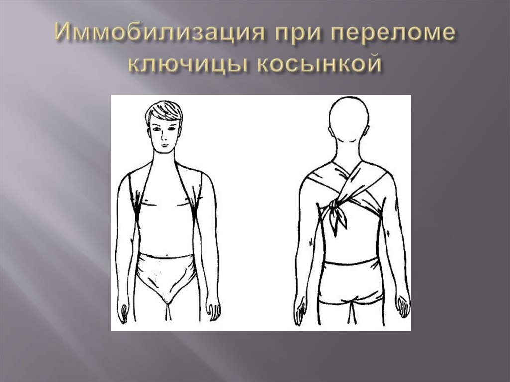 Иммобилизация при переломе ключицы косынкой