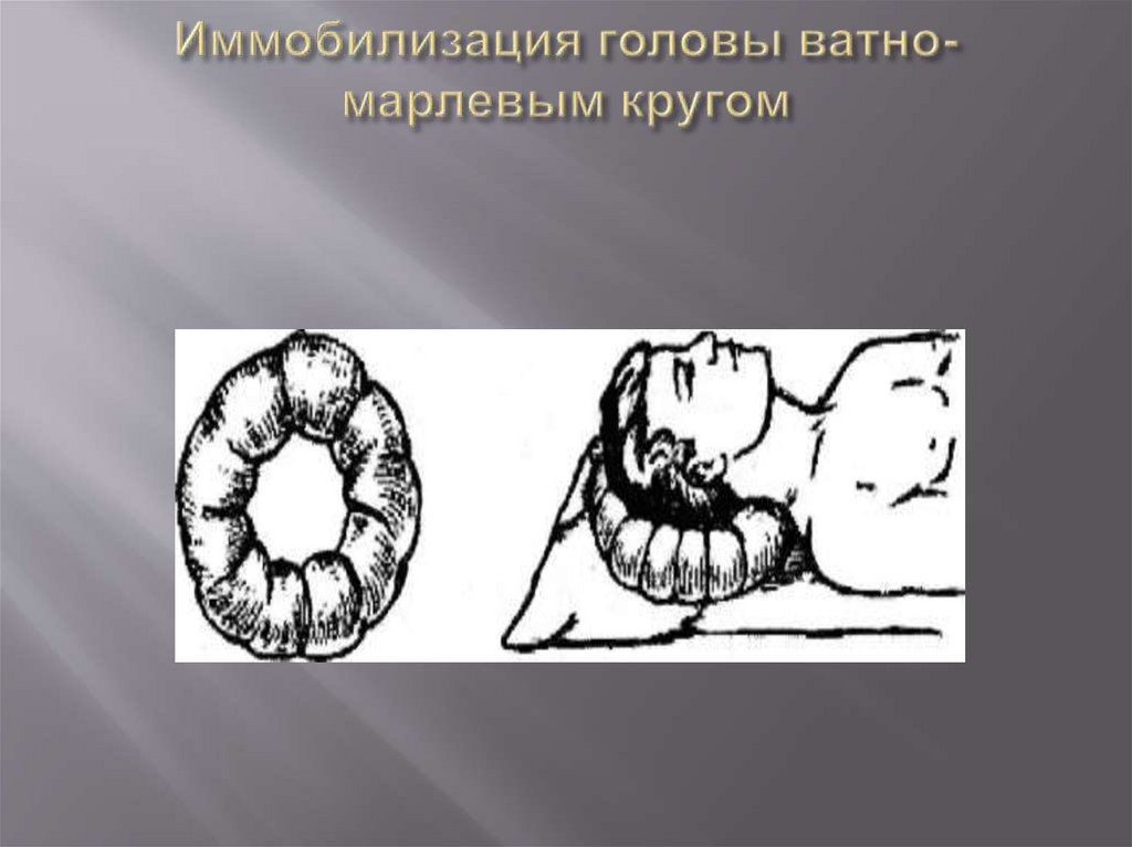 Иммобилизация головы ватно-марлевым кругом