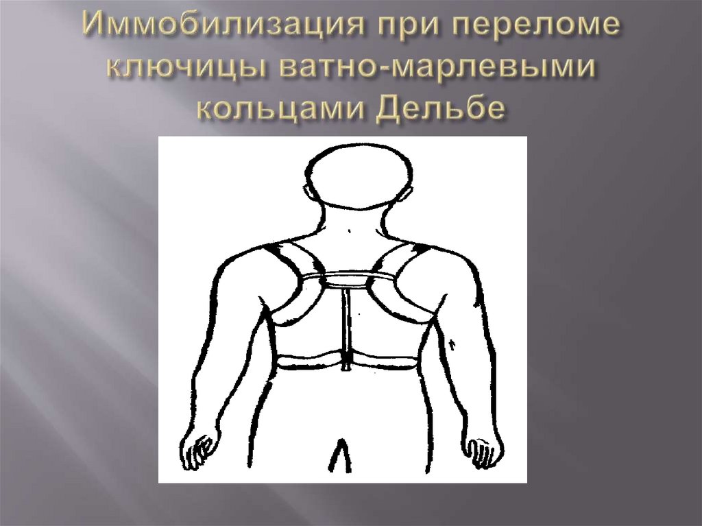 Иммобилизация при переломе ключицы ватно-марлевыми кольцами Дельбе