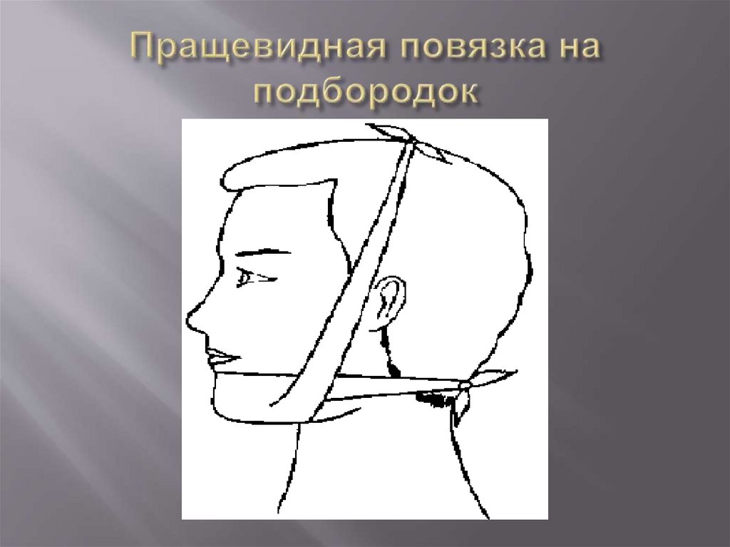 Пращевидная повязка на подбородок