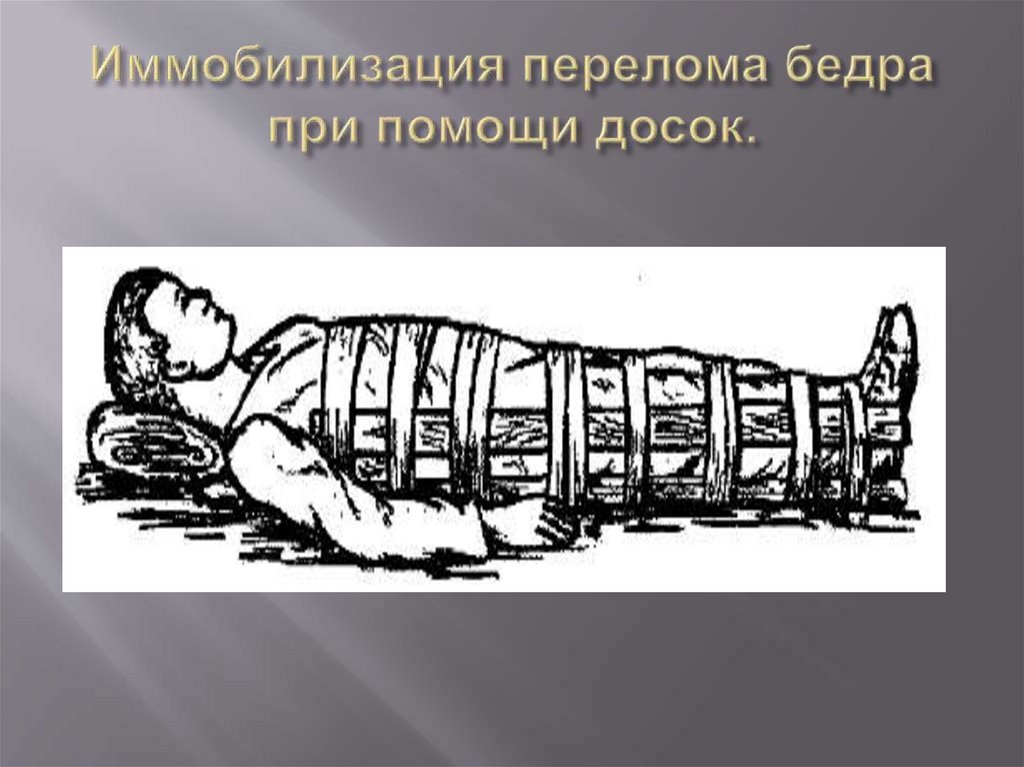 Иммобилизация перелома бедра при помощи досок.