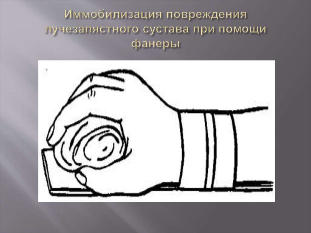 Иммобилизация повреждения лучезапястного сустава при помощи фанеры