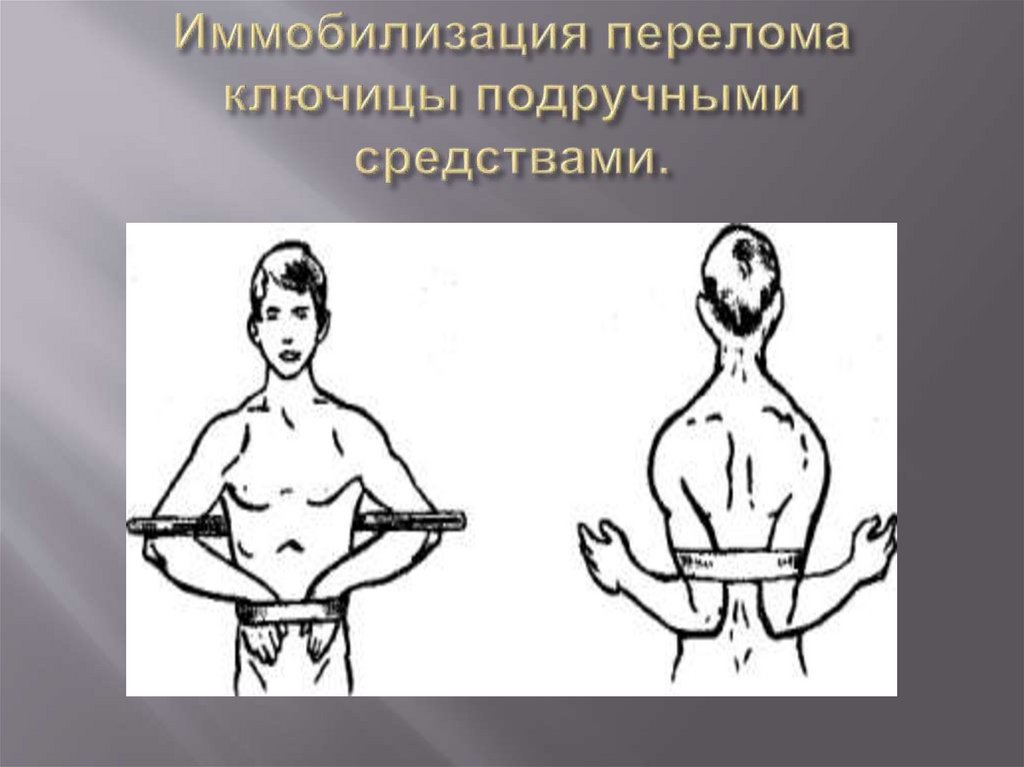 Иммобилизация перелома ключицы подручными средствами.