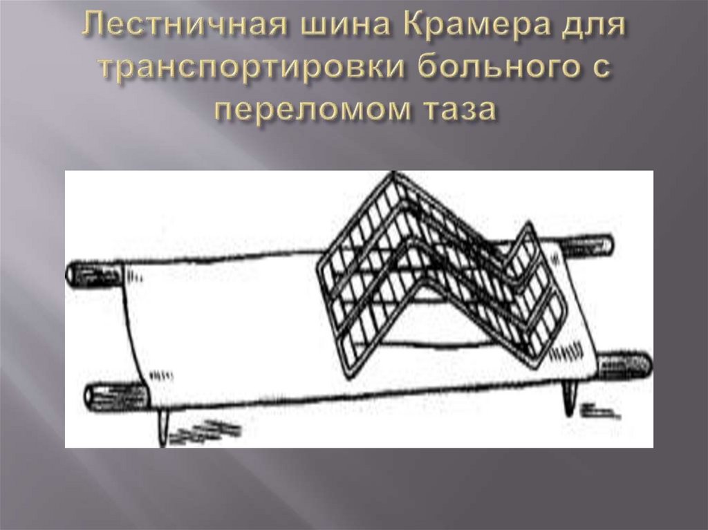 Лестничная шина Крамера для транспортировки больного с переломом таза