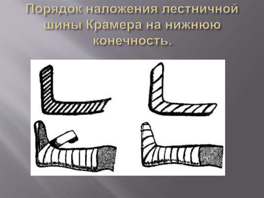 Порядок наложения лестничной шины Крамера на нижнюю конечность.