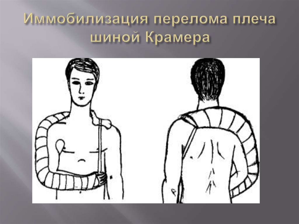 Иммобилизация перелома плеча шиной Крамера