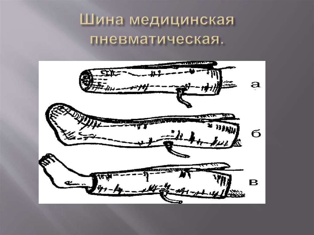 Шина медицинская пневматическая.