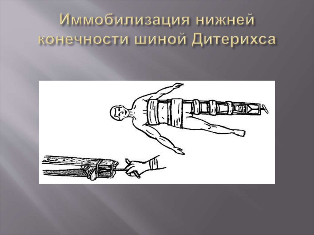 Иммобилизация нижней конечности шиной Дитерихса