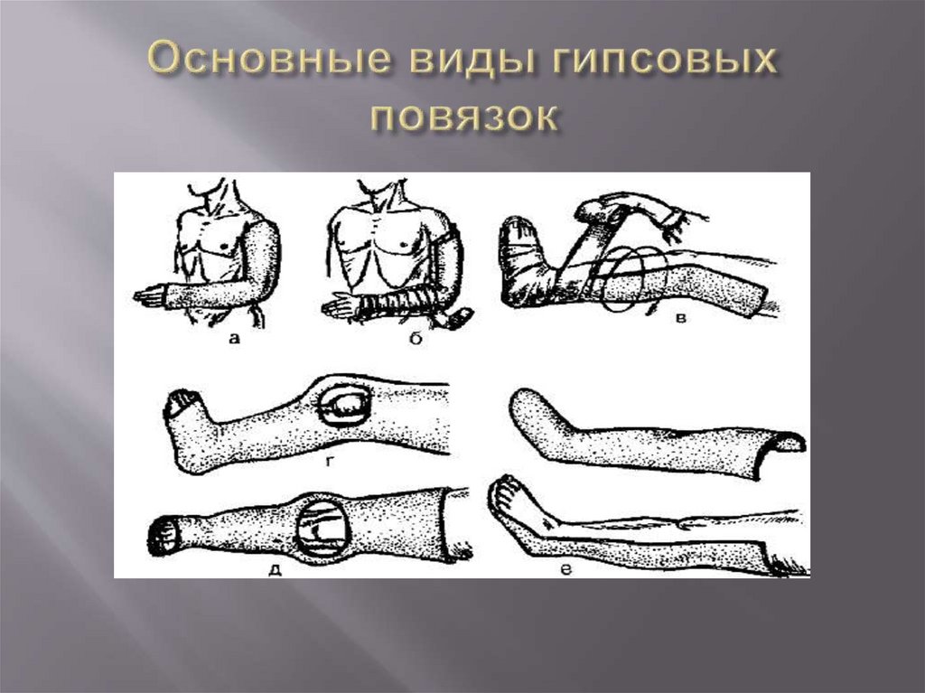 Основные виды гипсовых повязок