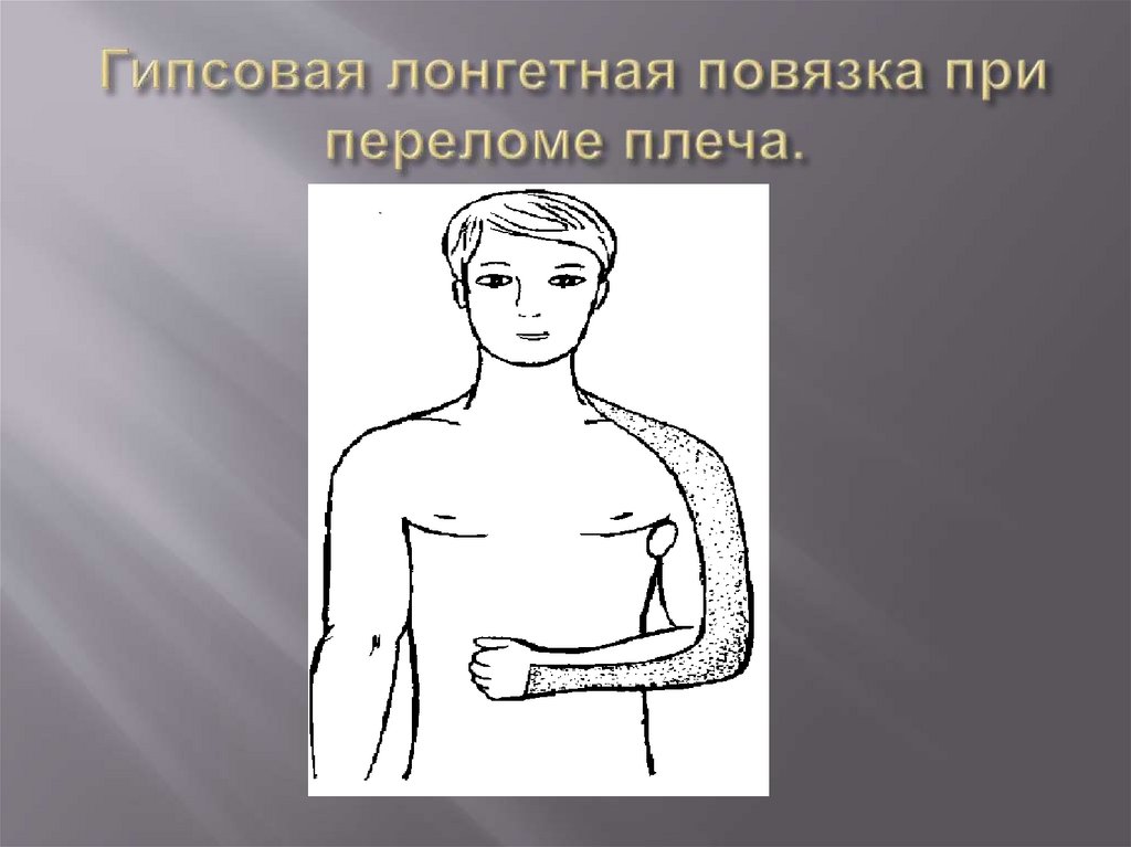 Гипсовая лонгетная повязка при переломе плеча.