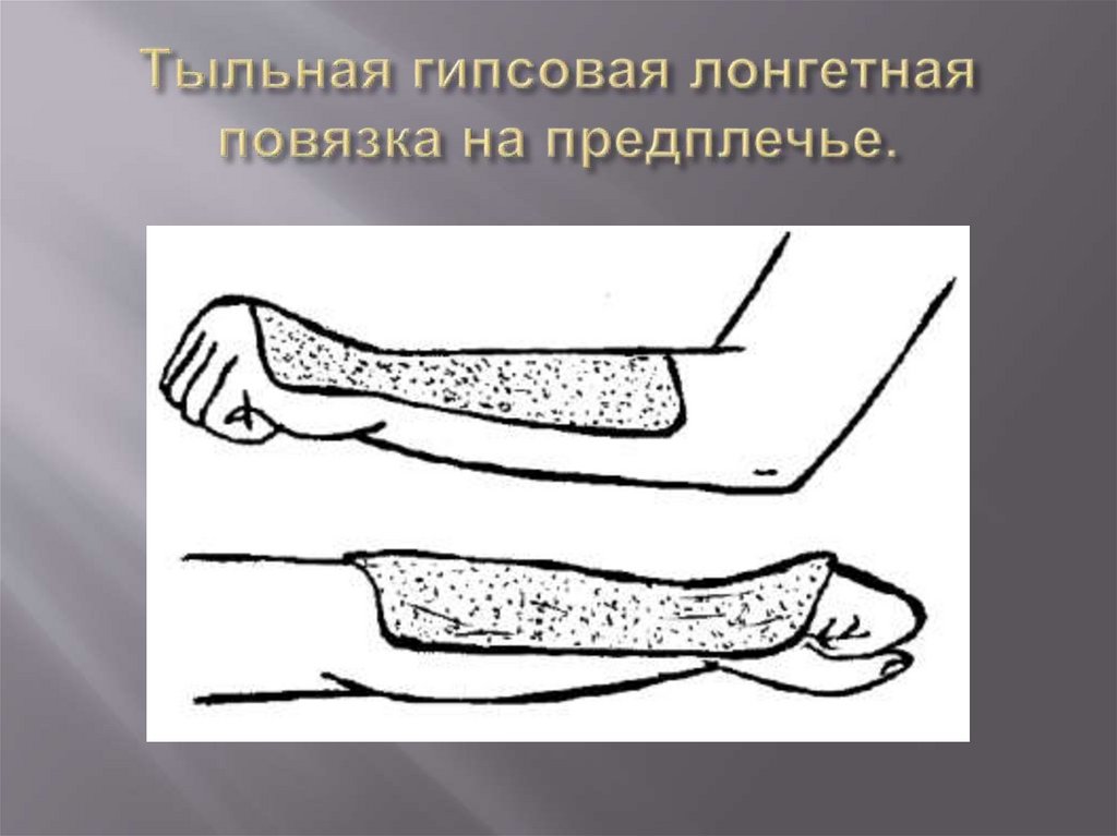 Тыльная гипсовая лонгетная повязка на предплечье.