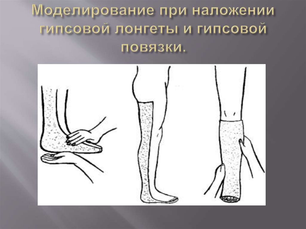 Моделирование при наложении гипсовой лонгеты и гипсовой повязки.