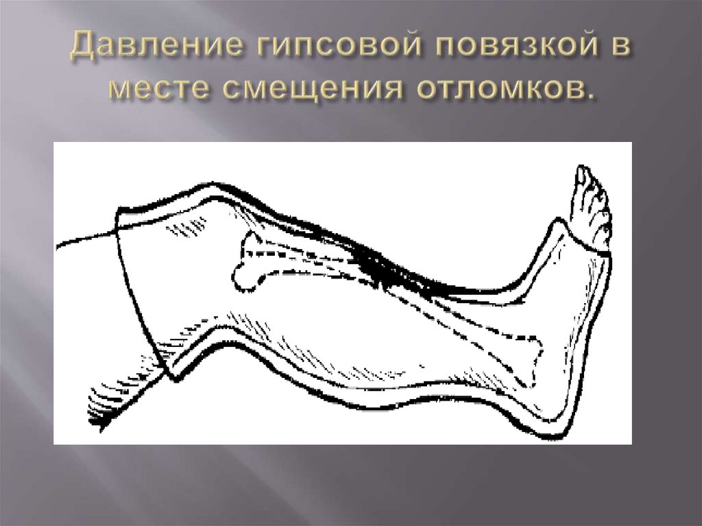 Давление гипсовой повязкой в месте смещения отломков.