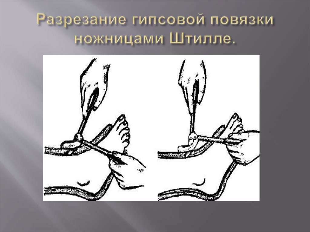 Разрезание гипсовой повязки ножницами Штилле.