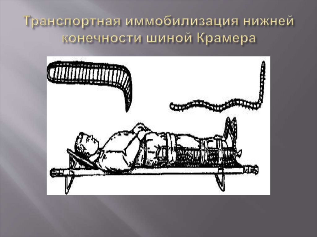 Транспортная иммобилизация нижней конечности шиной Крамера