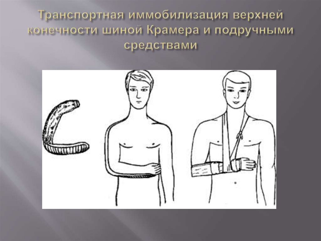 Транспортная иммобилизация верхней конечности шиной Крамера и подручными средствами