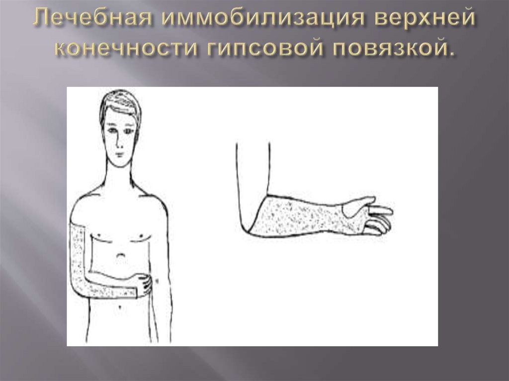 Лечебная иммобилизация верхней конечности гипсовой повязкой.
