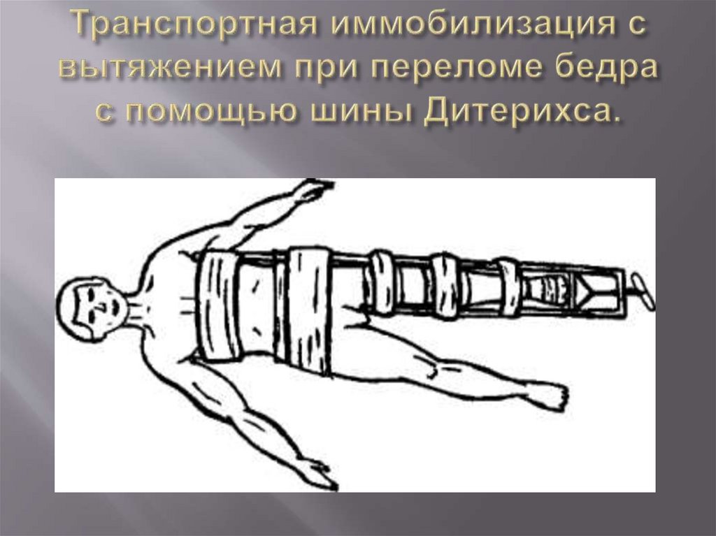 Транспортная иммобилизация с вытяжением при переломе бедра с помощью шины Дитерихса.