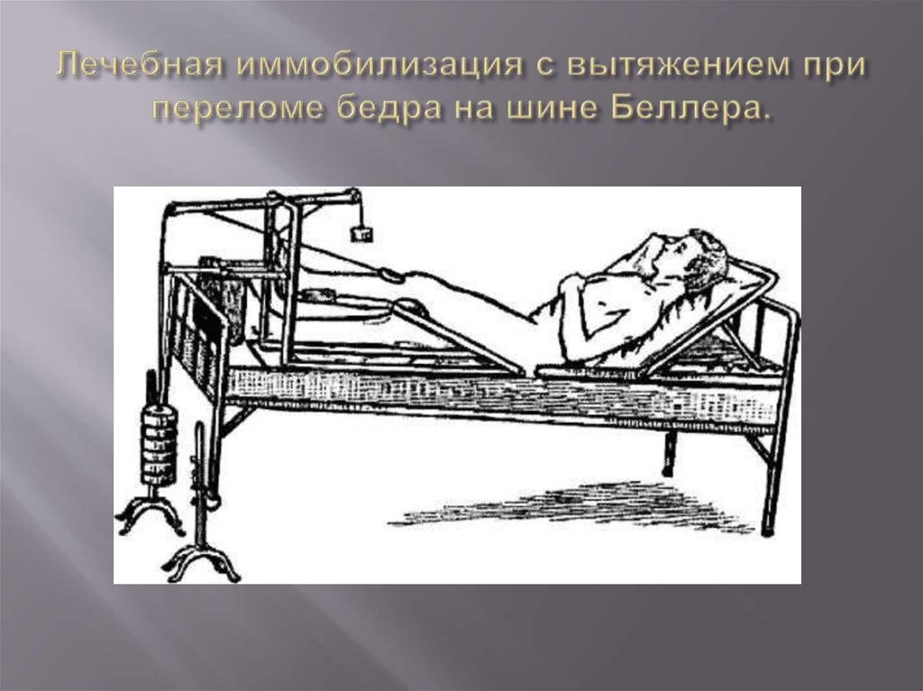 Лечебная иммобилизация с вытяжением при переломе бедра на шине Беллера.