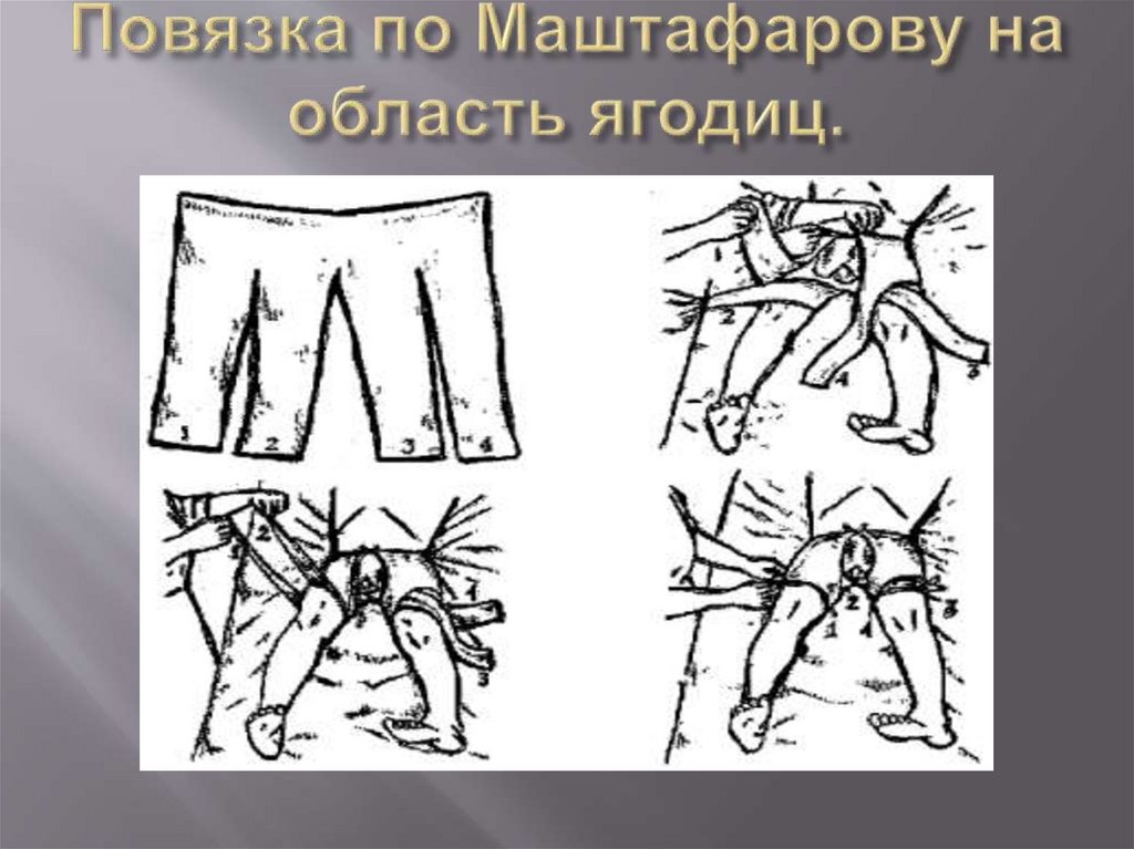 Повязка по Маштафарову на область ягодиц.