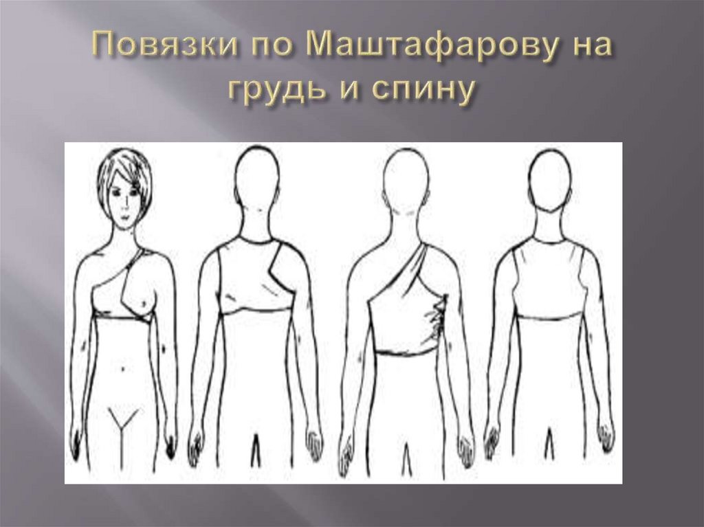 Повязки по Маштафарову на грудь и спину