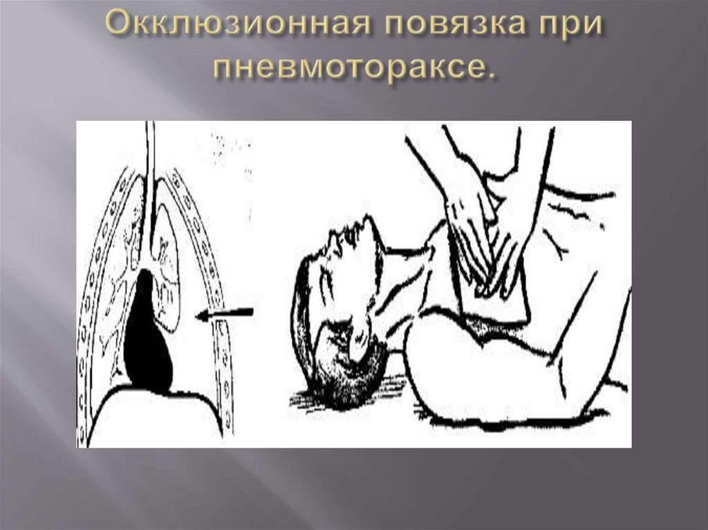 Окклюзионная повязка при пневмотораксе.