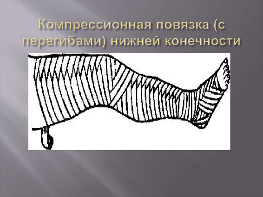 Компрессионная повязка (с перегибами) нижней конечности