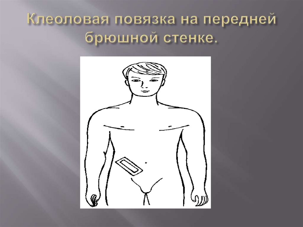 Клеоловая повязка на передней брюшной стенке.