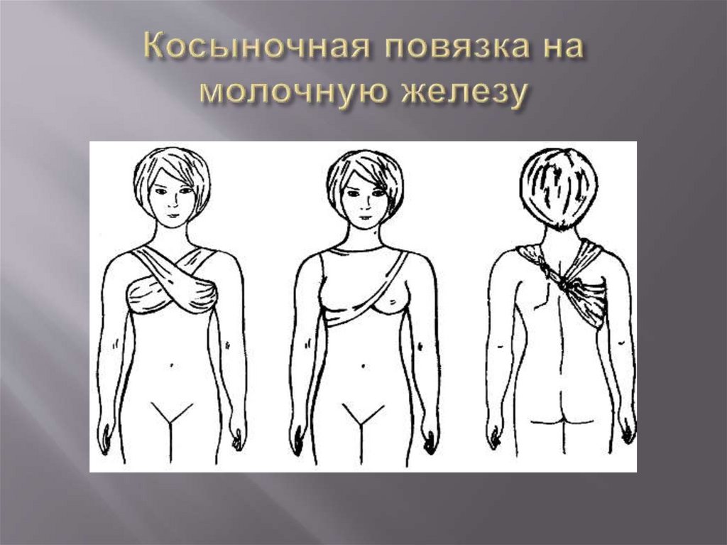 Косыночная повязка на молочную железу