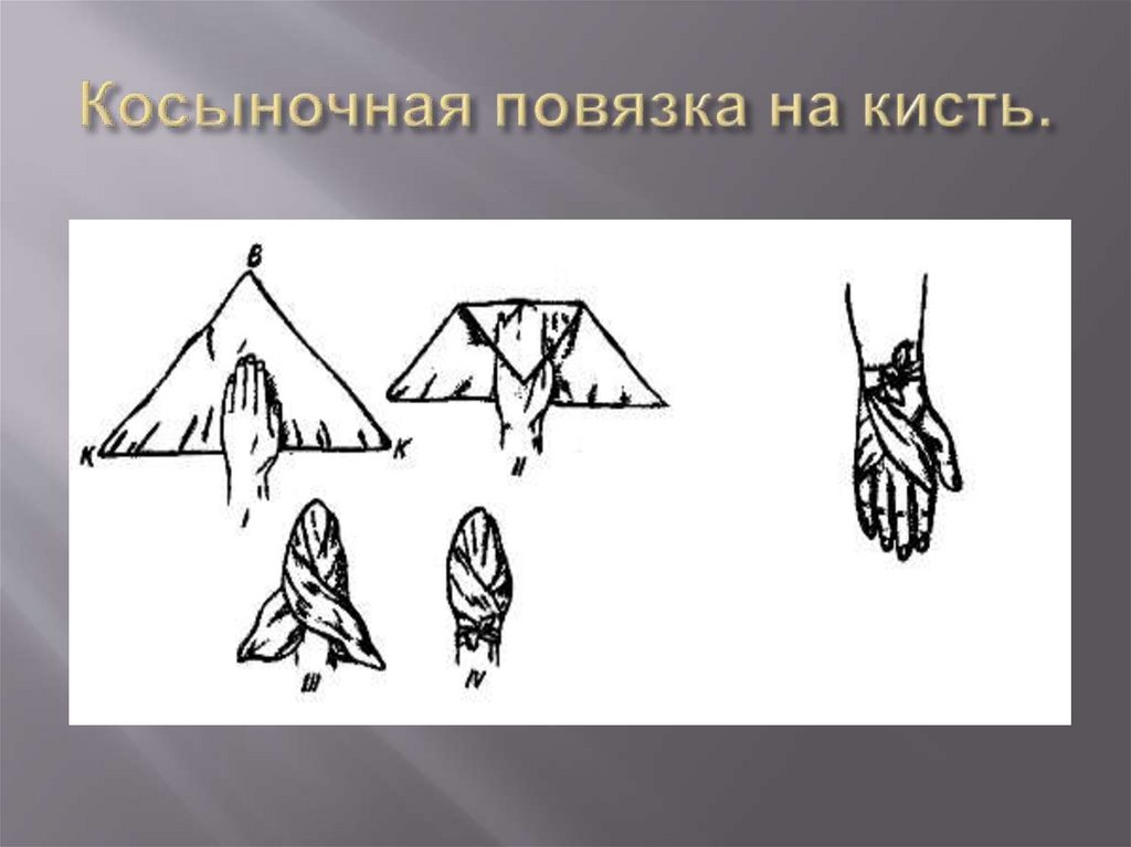 Косыночная повязка на кисть.