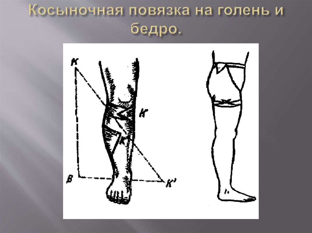 Косыночная повязка на голень и бедро.