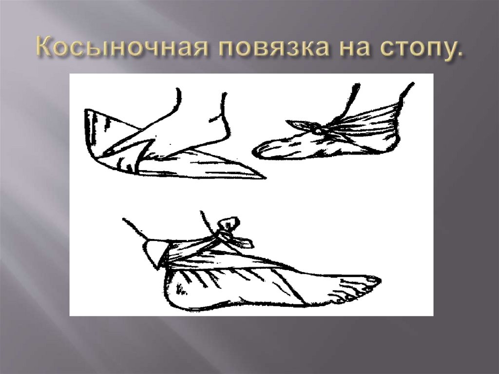 Косыночная повязка на стопу.