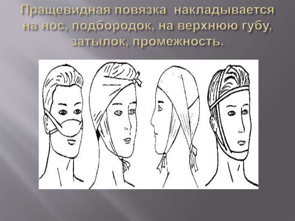 Пращевидная повязка накладывается на нос, подбородок, на верхнюю губу, затылок, промежность.