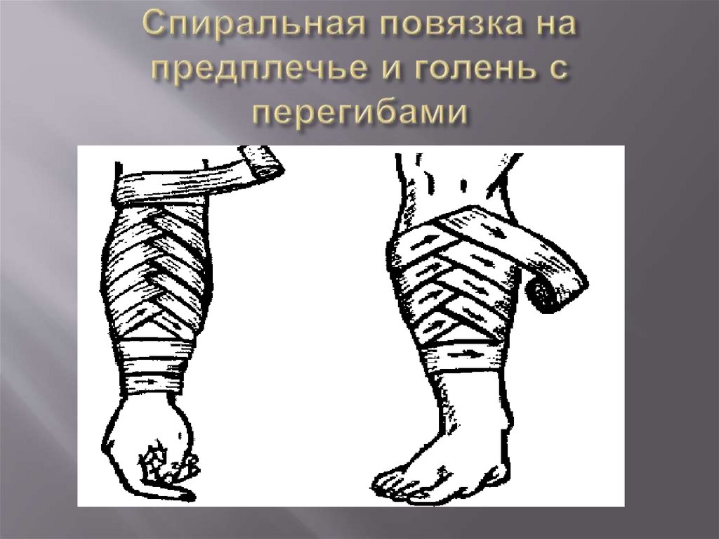 Спиральная повязка на предплечье и голень с перегибами