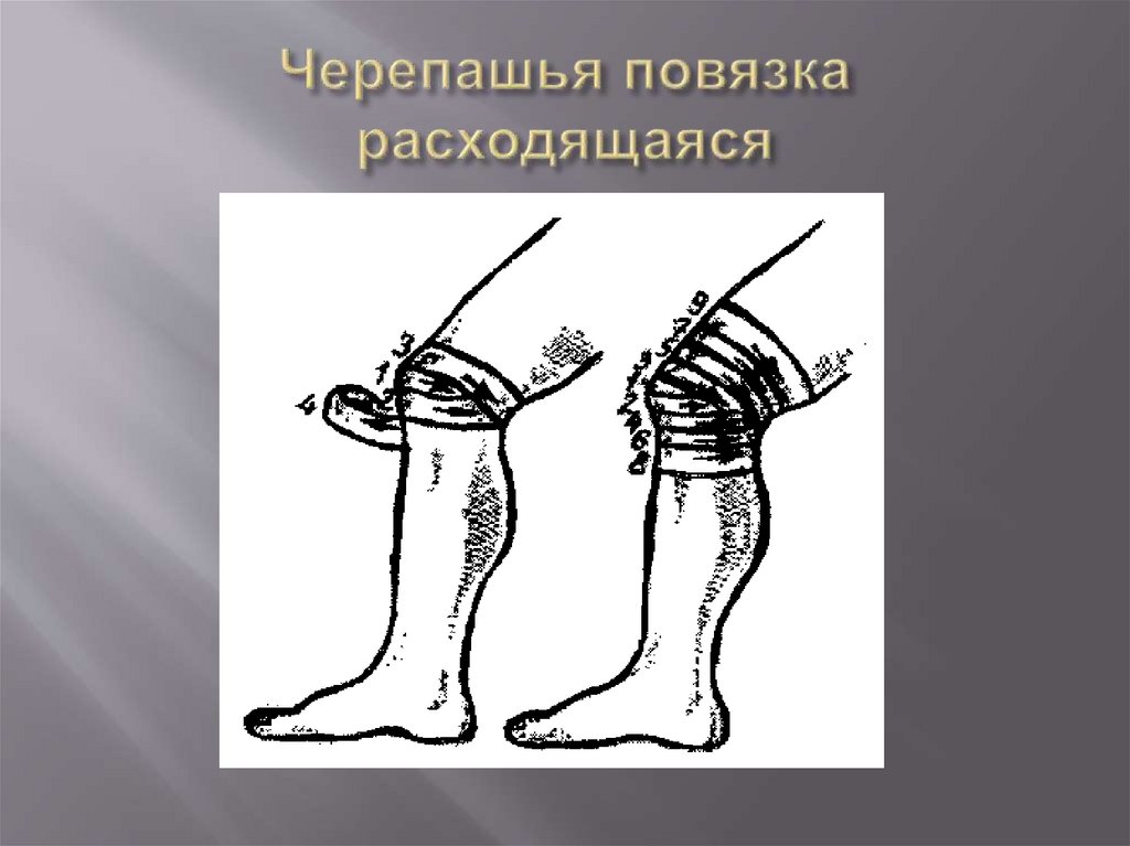 Черепашья повязка расходящаяся