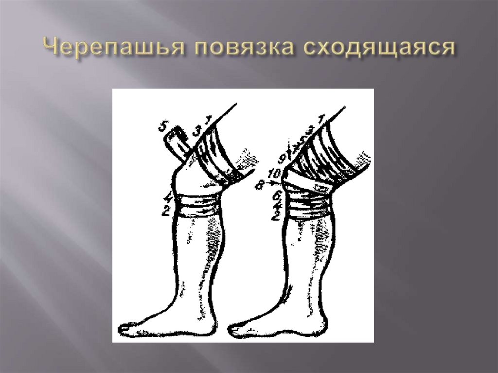 Черепашья повязка сходящаяся