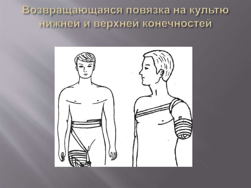 Возвращающаяся повязка на культю нижней и верхней конечностей